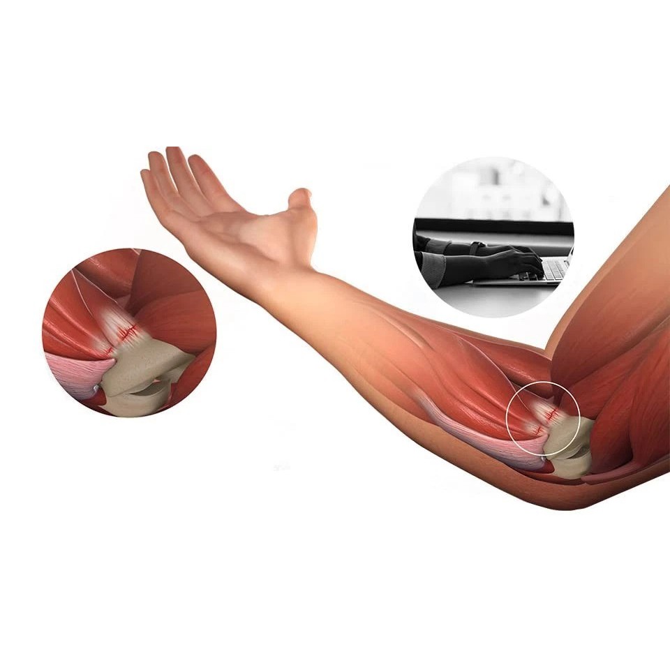 Tennis Elbow Brace Support Arthritis Tendonitis Golfer Arm Joint Pain Band Strap