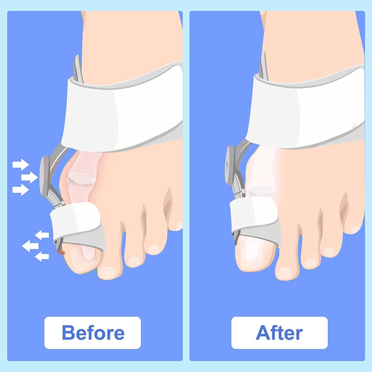 Bunion Splint Big Toe Straightener Corrector Knob Hallux Valgus Orthopedic Strap