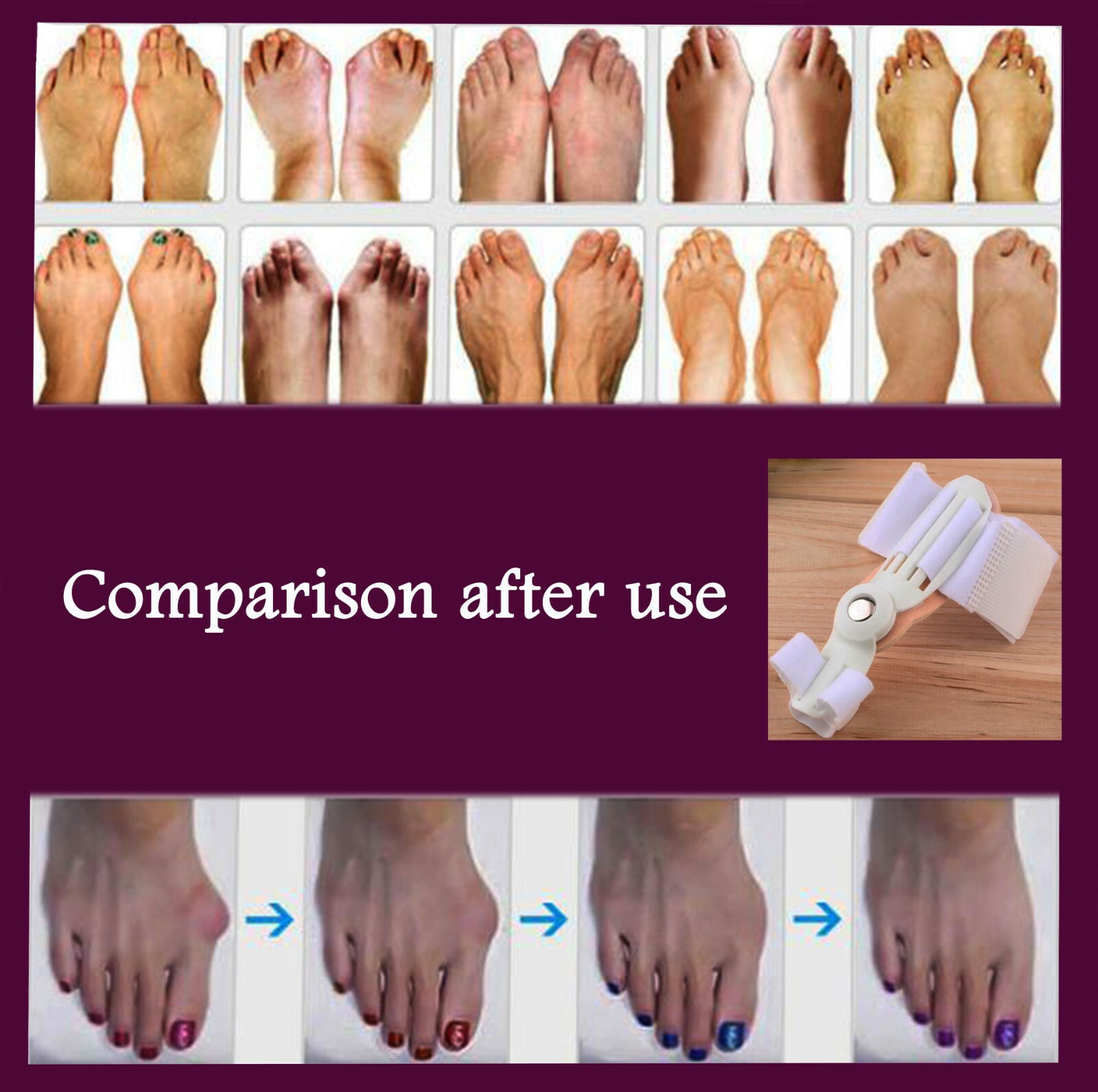 Bunion Corrector relief foot pads for men & women’s(1 pair )-BRCFP