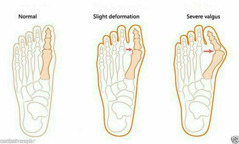 2 Pcs Gel Big Toe Bunion Guards Toe Spreaders Pain Relief Crooked Overlapping