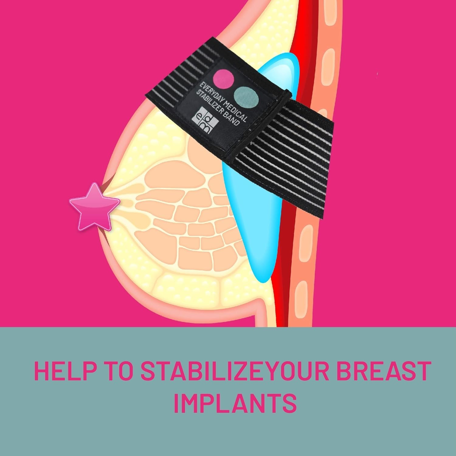 Implant Stabilizer Band I Post Surgery Augmentation and Reduction Strap I Che…