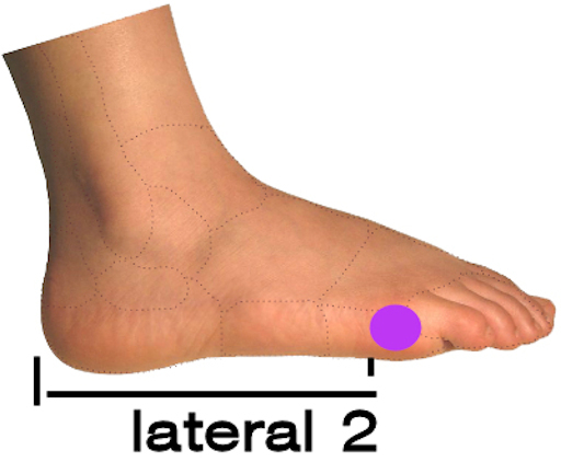 Foot Arch support – Pre-made POLYpropylene size 5 – 13, optional cover flat heel