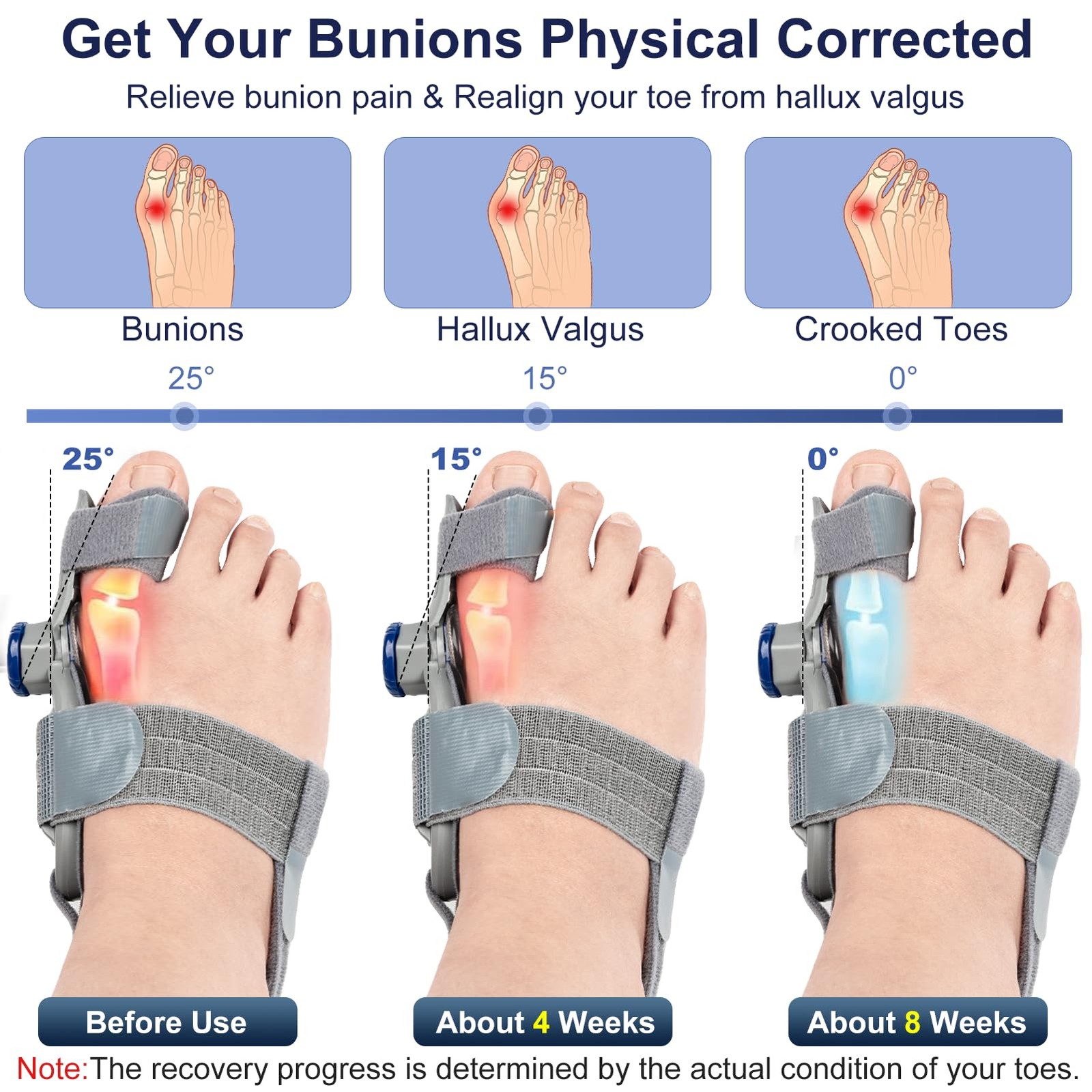 Gloserin JZJZQ Bunion Corrector Splint Adjustable Big Toe Straightener Gray