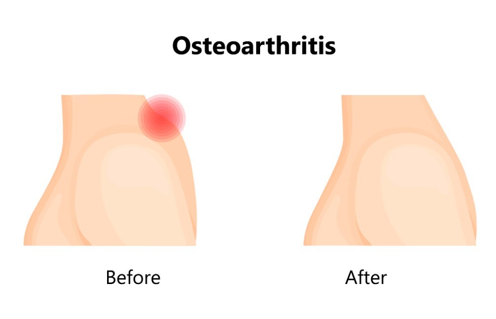 10 Packs Joint And Back Pain 100% Cream ARTROPANT Osteochondrosis Arthrosis