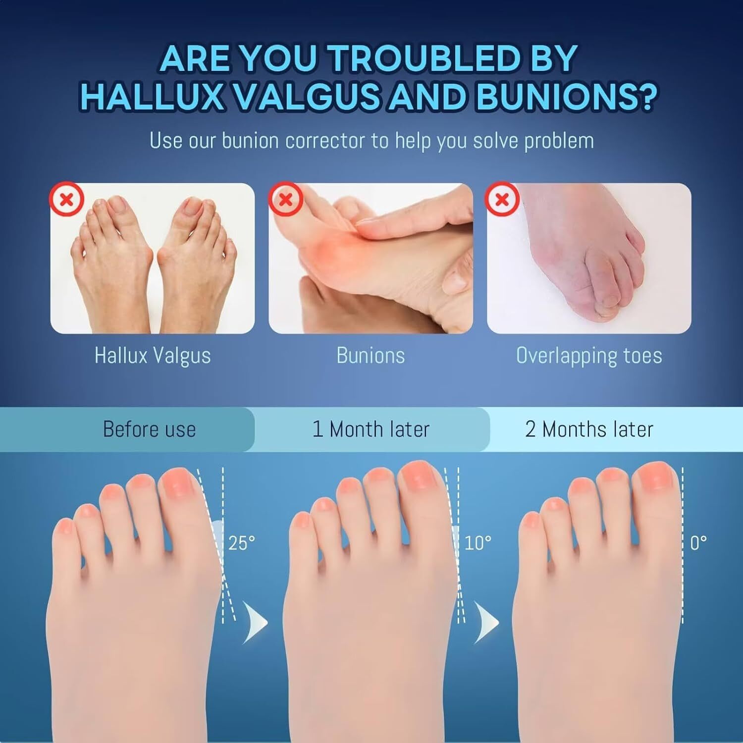 Adjustable Hallux Valgus Bunion Corrector Splints Straightener Big Toe Corrector
