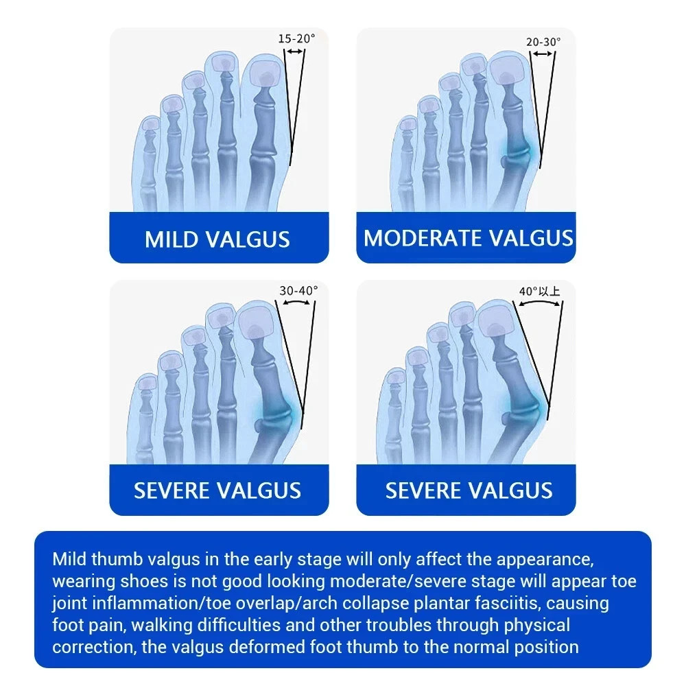 Bunion Fix Toe Valgus Corrector Adjustable Orthosis Women Men Splints