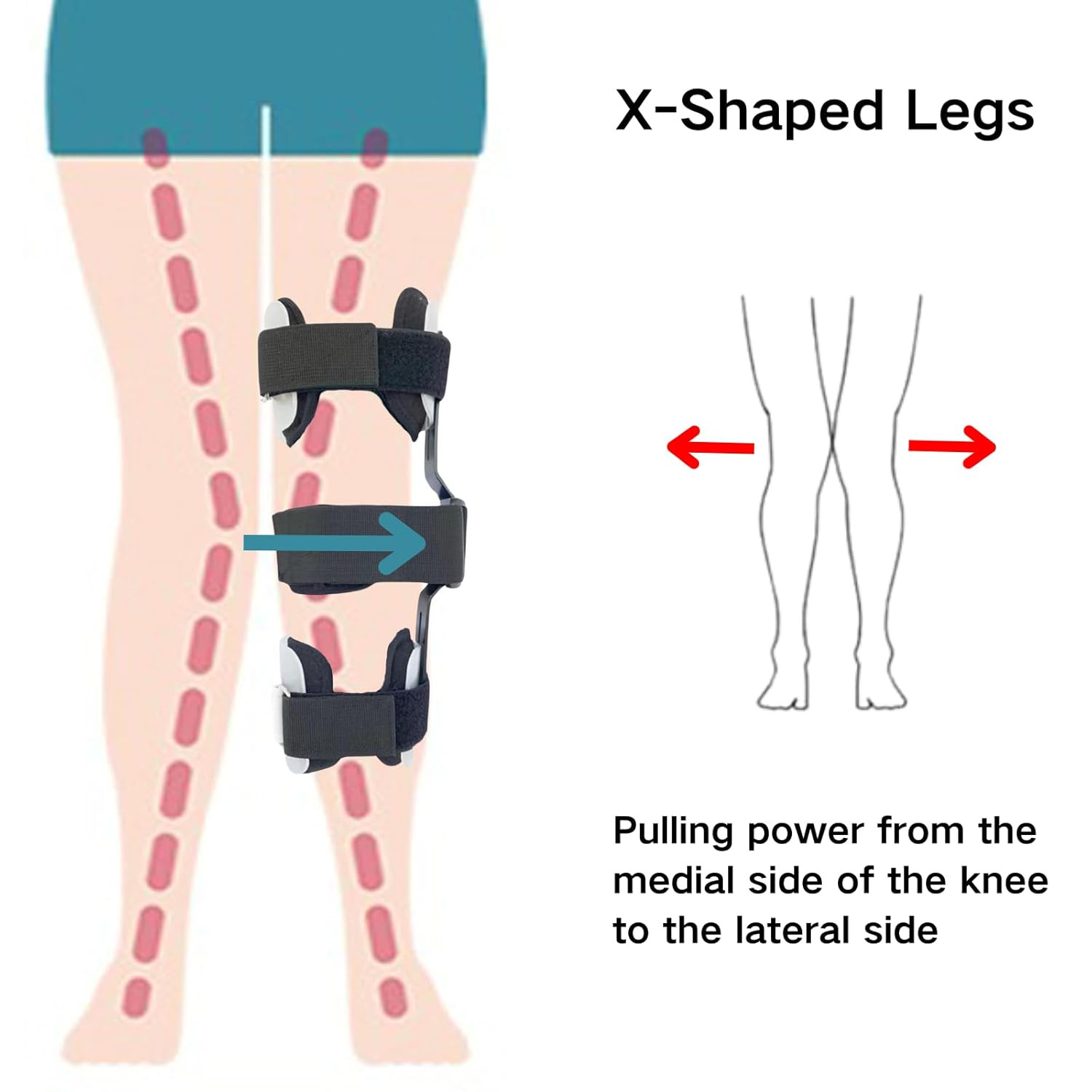 Kids Leg Posture Corrector Brace for O/X Legs & Bow Legs – Knee Support