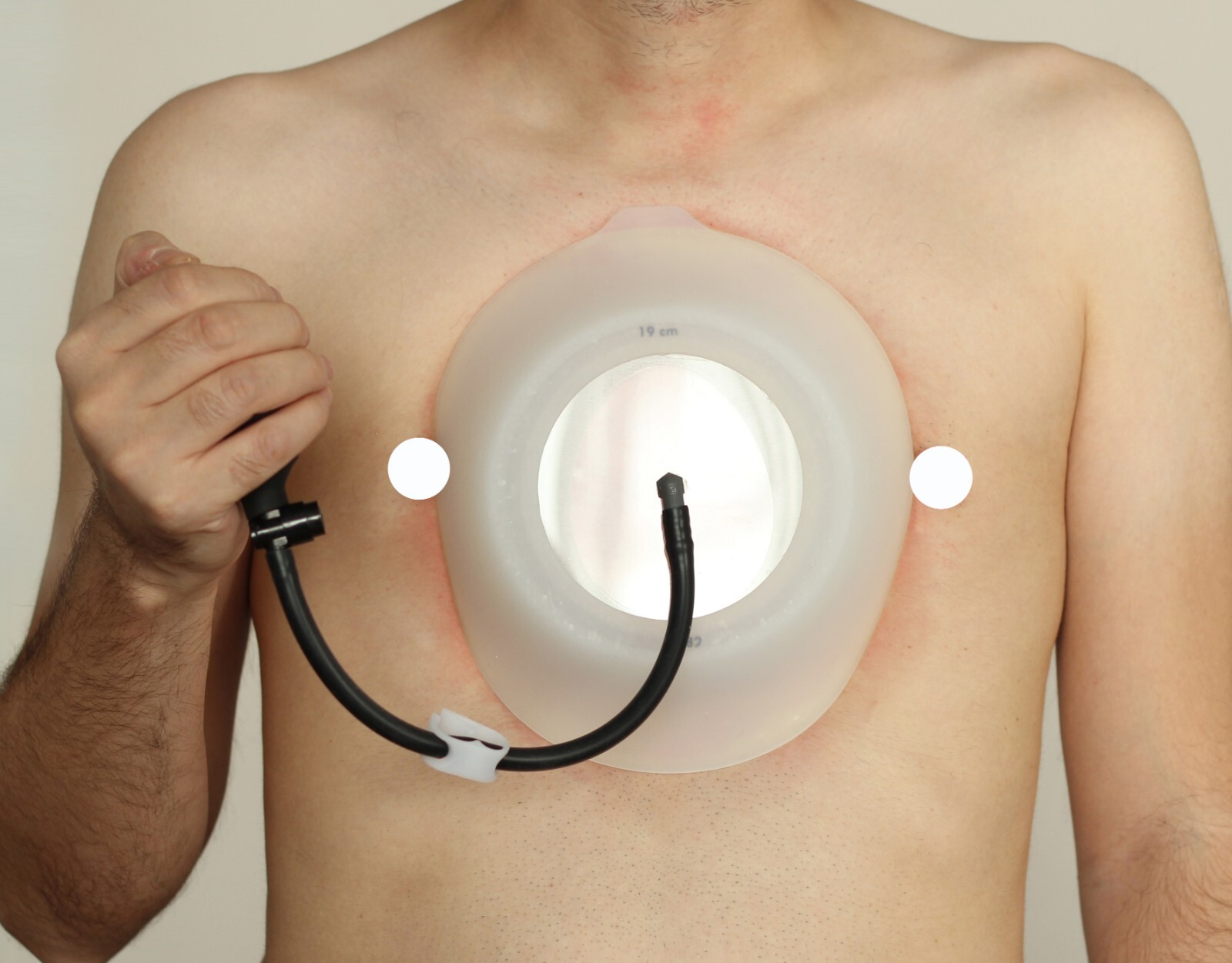 Vacuum Bell 19cm (XL) Pectus Excavatum