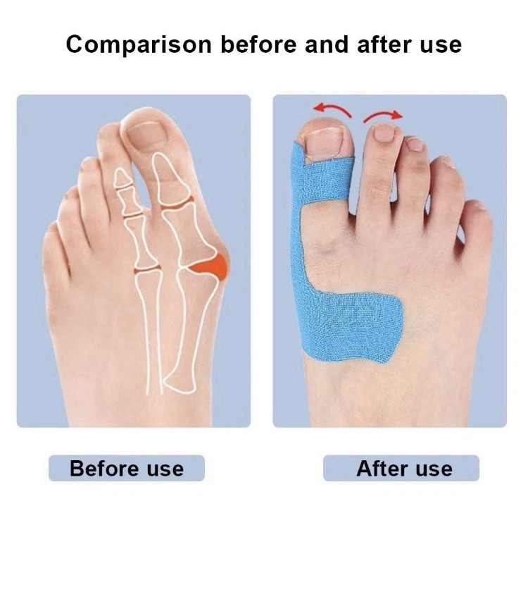 SPRRTOOR Self-Adhesive Toe Corrector Stabilization Tape 10pcs Blue/Black/Beige