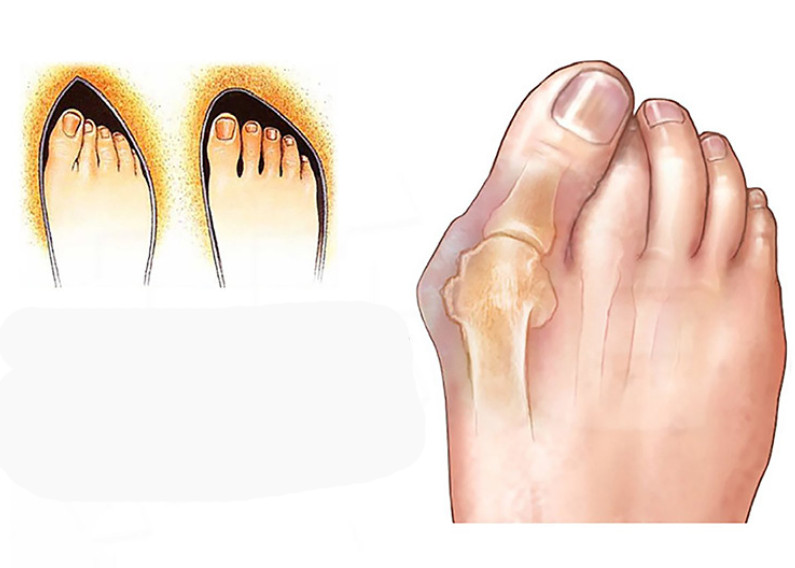 Unisex Toe Corrector Halux Valgus Splint Bunion Relief Straightener Foot Care