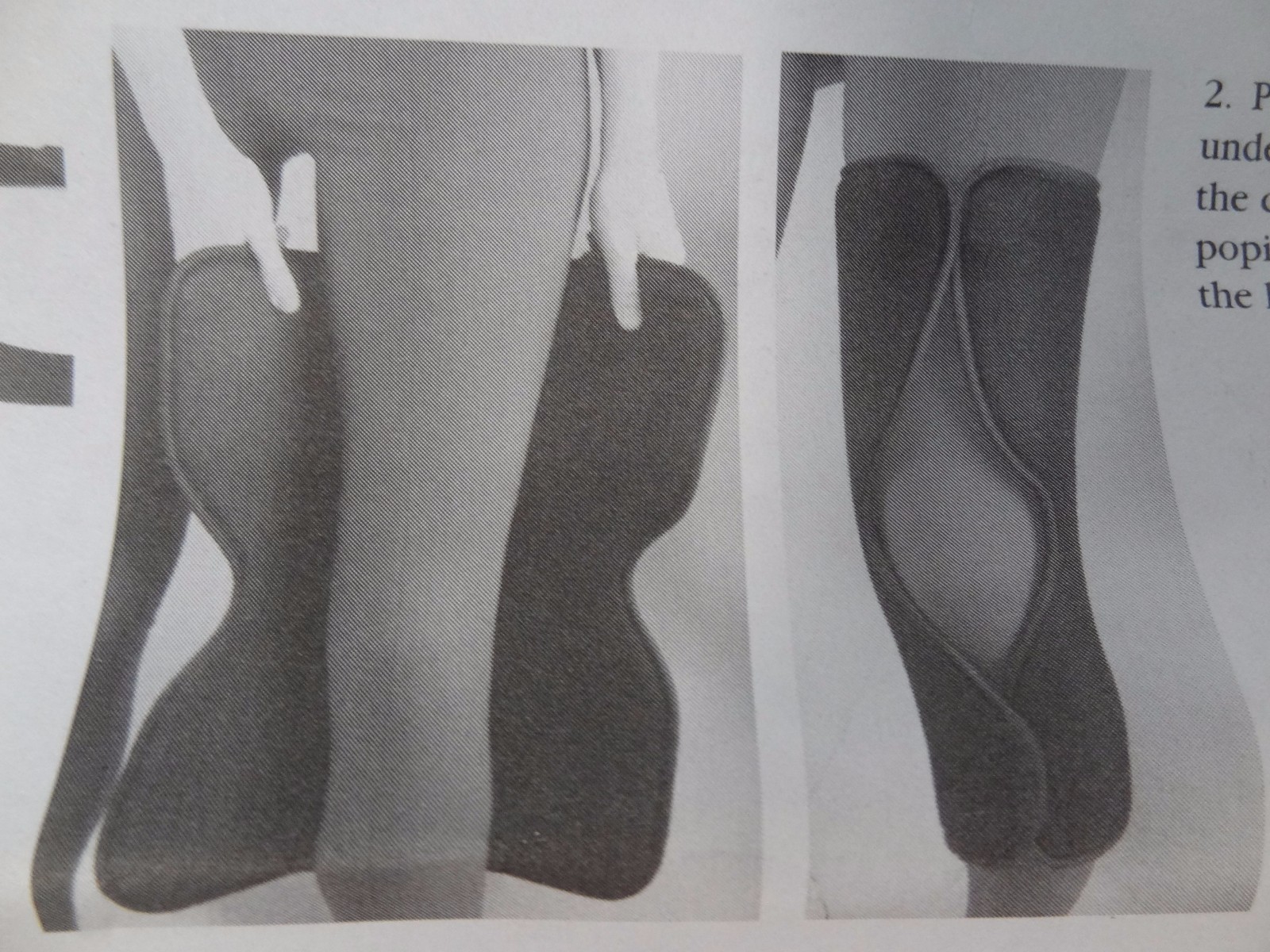 Sammons Preston Tri-Panel Knee Immobilizer 22″ ~ Black ~ 55067904