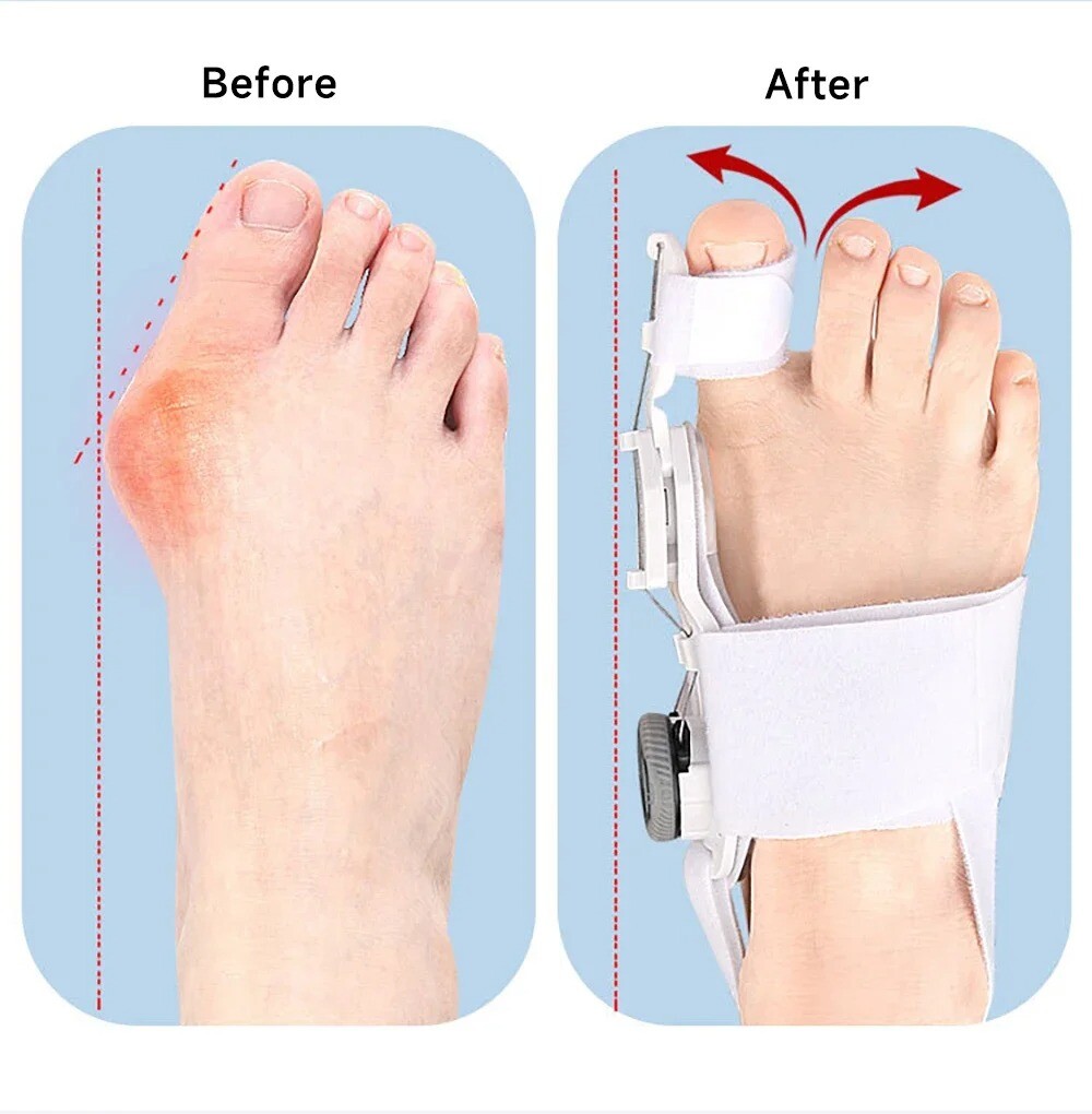 Medical Straightener Adjustable Separators Bunion Correctors Foot Pain Relief US