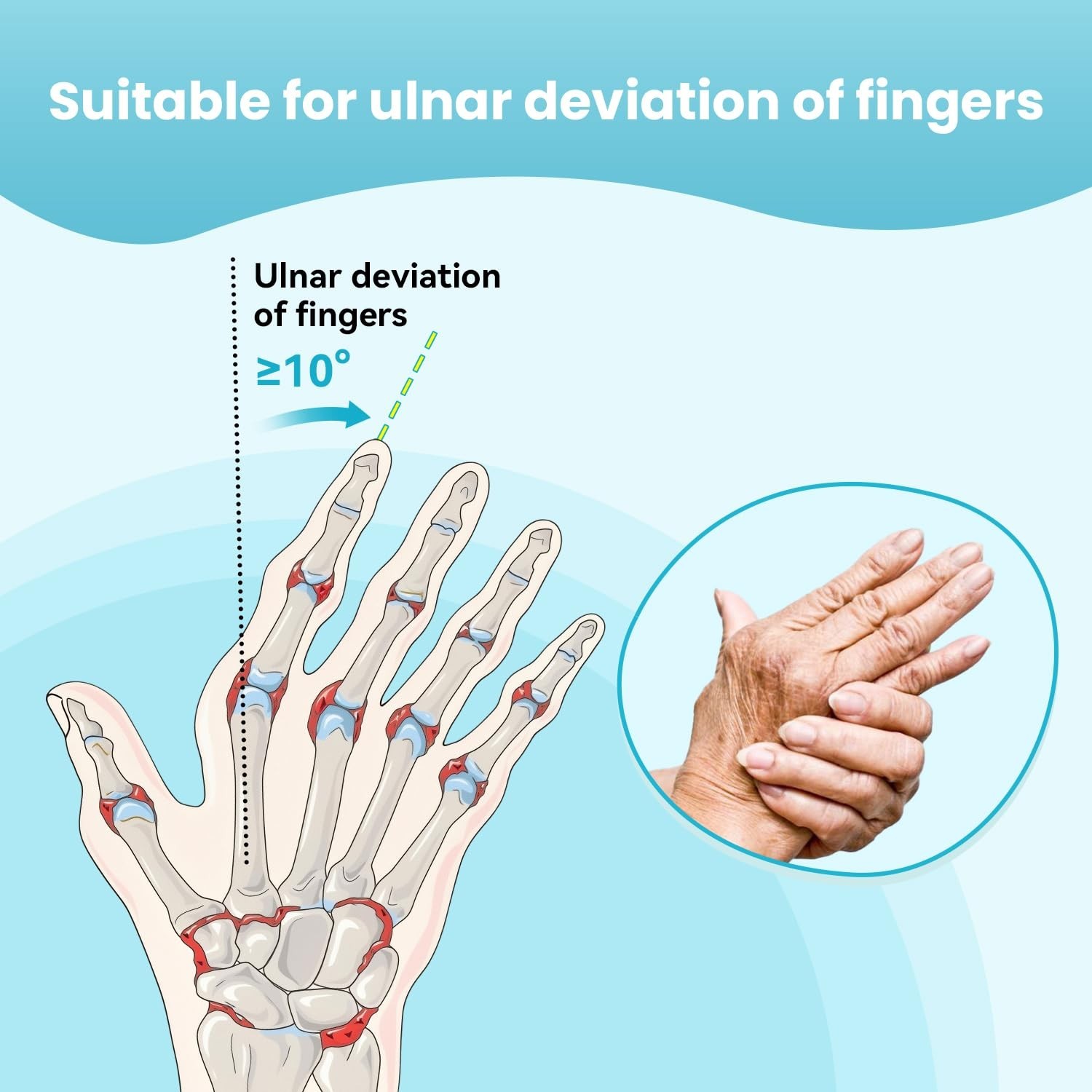 Finger Ulnar Deviation Splint Brace Deviation Orthopedic Corrector (Right-S/M)