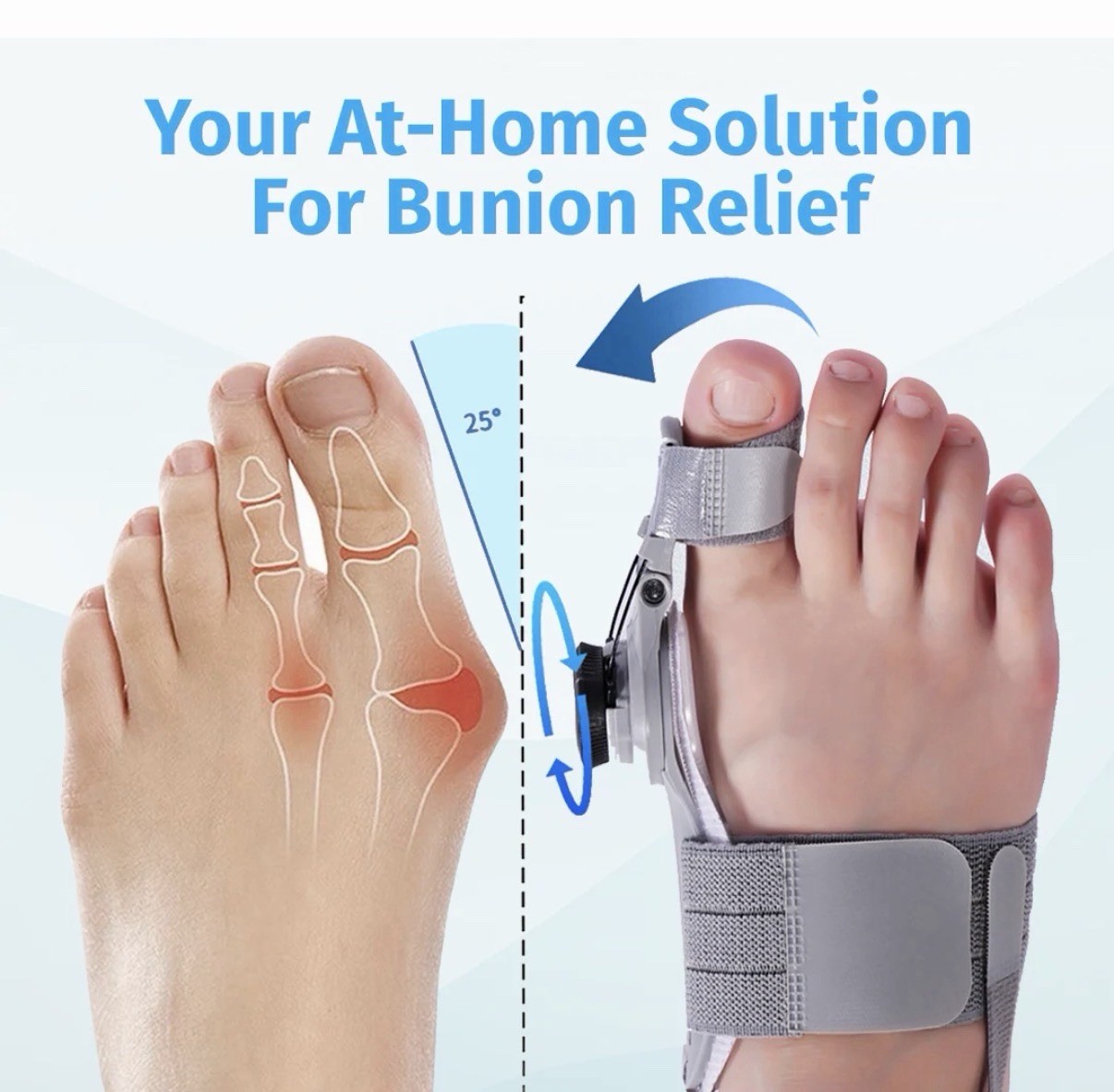 4 Treatmedy Bunion Fix + Orthopedic Bunion Sleeves. Natural Home Bunion Relief