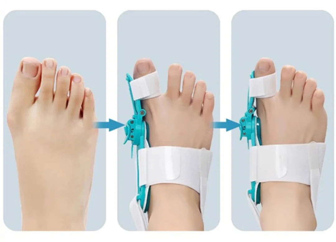 1 Pair Bunion Corrector Set Big Toe Straightener Bunion Splints Correction Tool