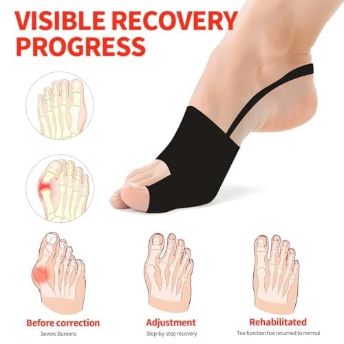 DorkTees 2PCS Bunion Corrector for Women & Men, Big Toe Straightener with Adjust