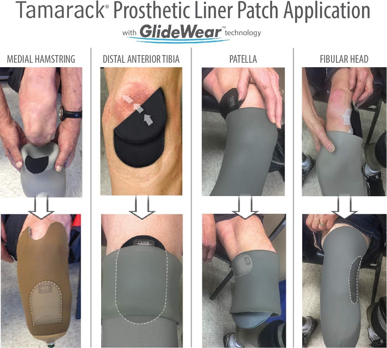 Tamarack Prosthetic Liner Patch with Technology Small, 2 Pack