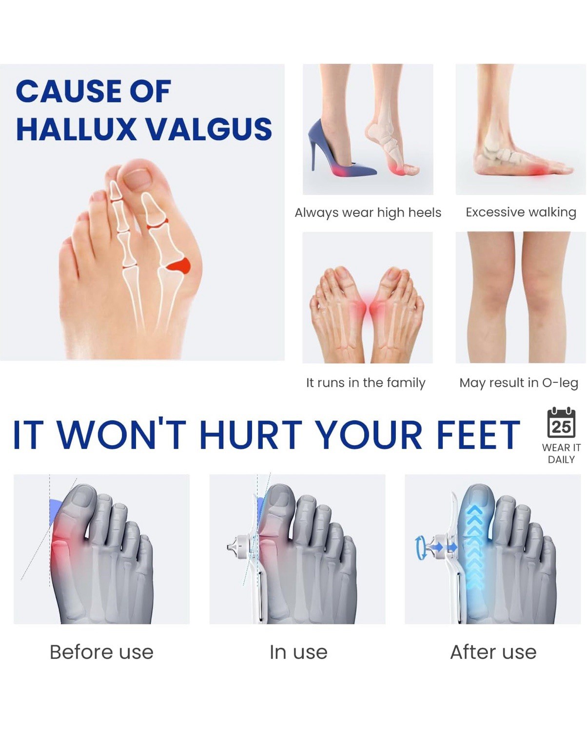 Bunion Corrector Splint for Big Toe – 3 Angle Plates, Hallux Valgus Relief