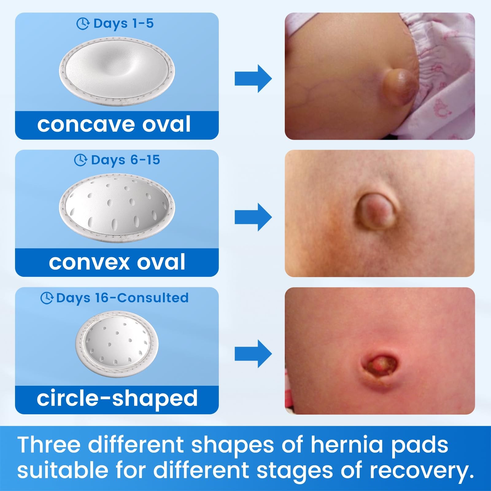 Velpeau Umbilical Hernia Belt Baby Newborn 3 Different Shaped Compression Pads