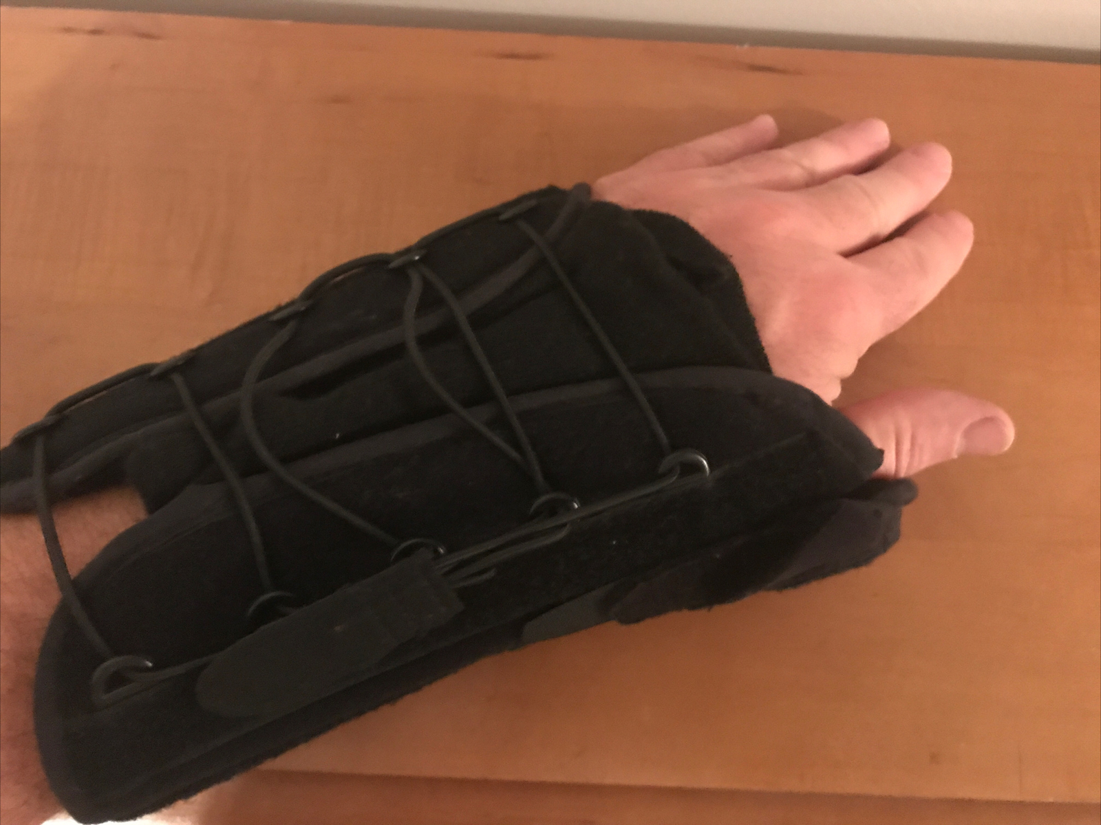 Left Hand Post Surgery Hand/Wrist/Thumb, Cast & Shoulder Sling