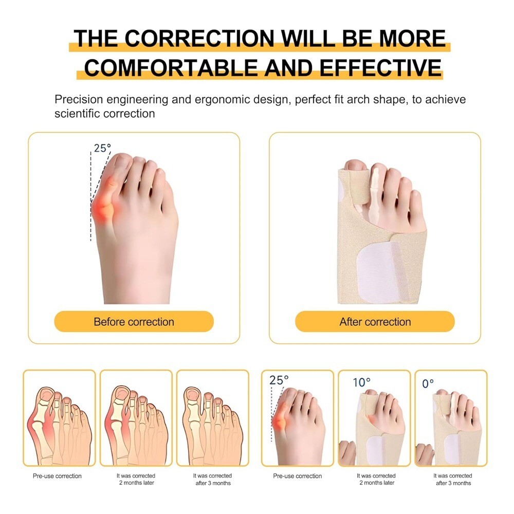 FOSVBEY 1-3Pairs Bunion Corrector for Women Men Orthopedic Hallux Valgus Splint