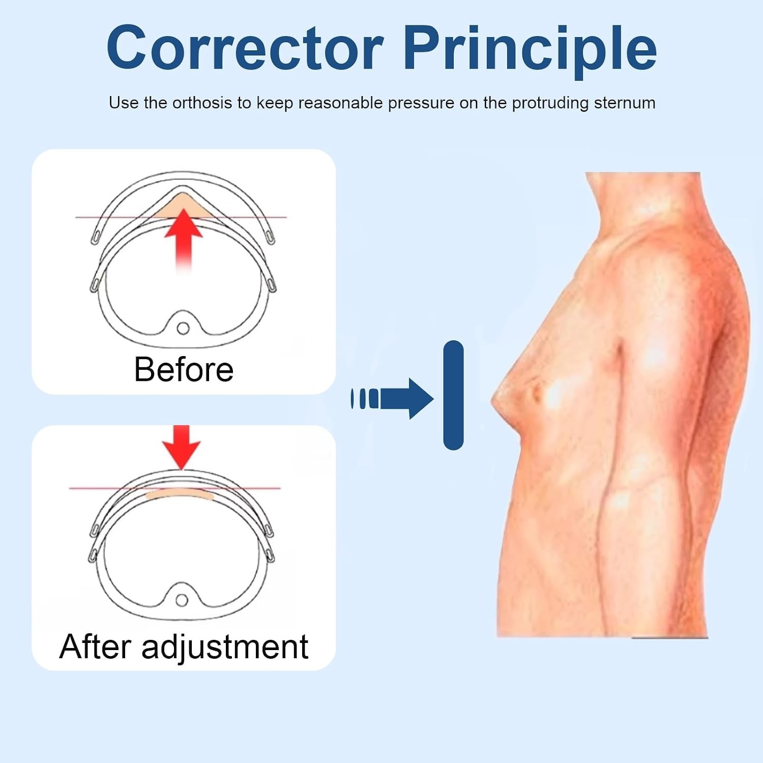 Lightweight Adjustable Chest Brace for Pectus Carinatum & Ribs Valgus Correction