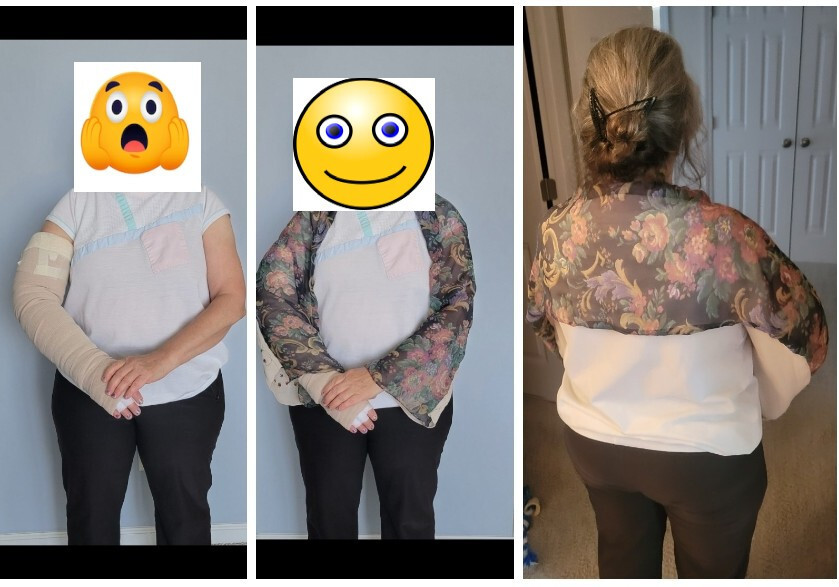 arm cast, lymphedema bandage fashionable sleeve covers shrug