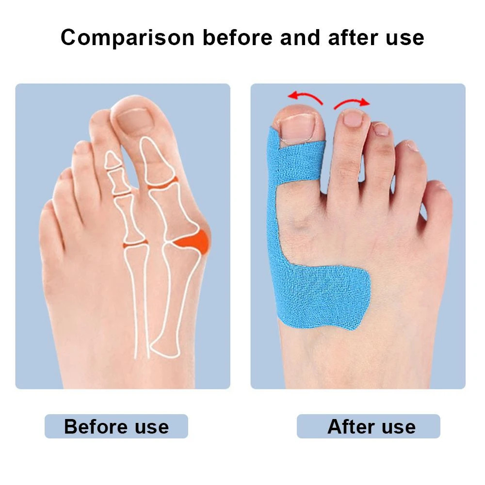10pcs Bunion Corrector Kinesiology Tape Big Toe Spacer Pain Relief Straightener