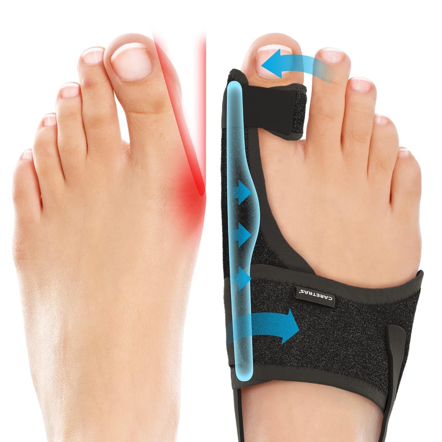 2-Pack Bunion Corrector for Women & Men, Orthopedic Bunion Splint for Hallux Val