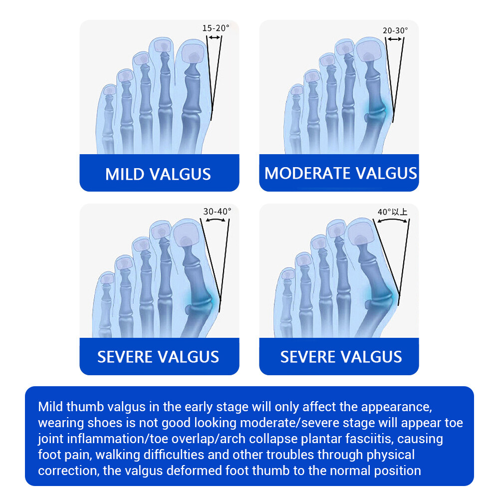 Bunion Fix Toe Valgus Corrector Adjustable Orthopedic Splints for Women and Men