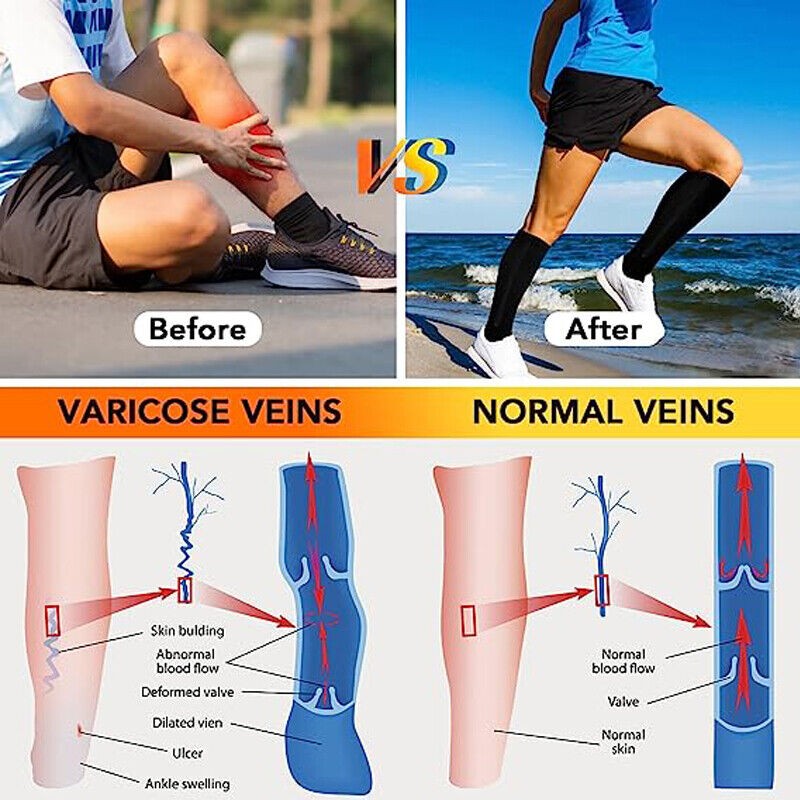 Zipper Compression Socks Open Toe 20-30mmHg Support Stocking Leg Calf Stockings