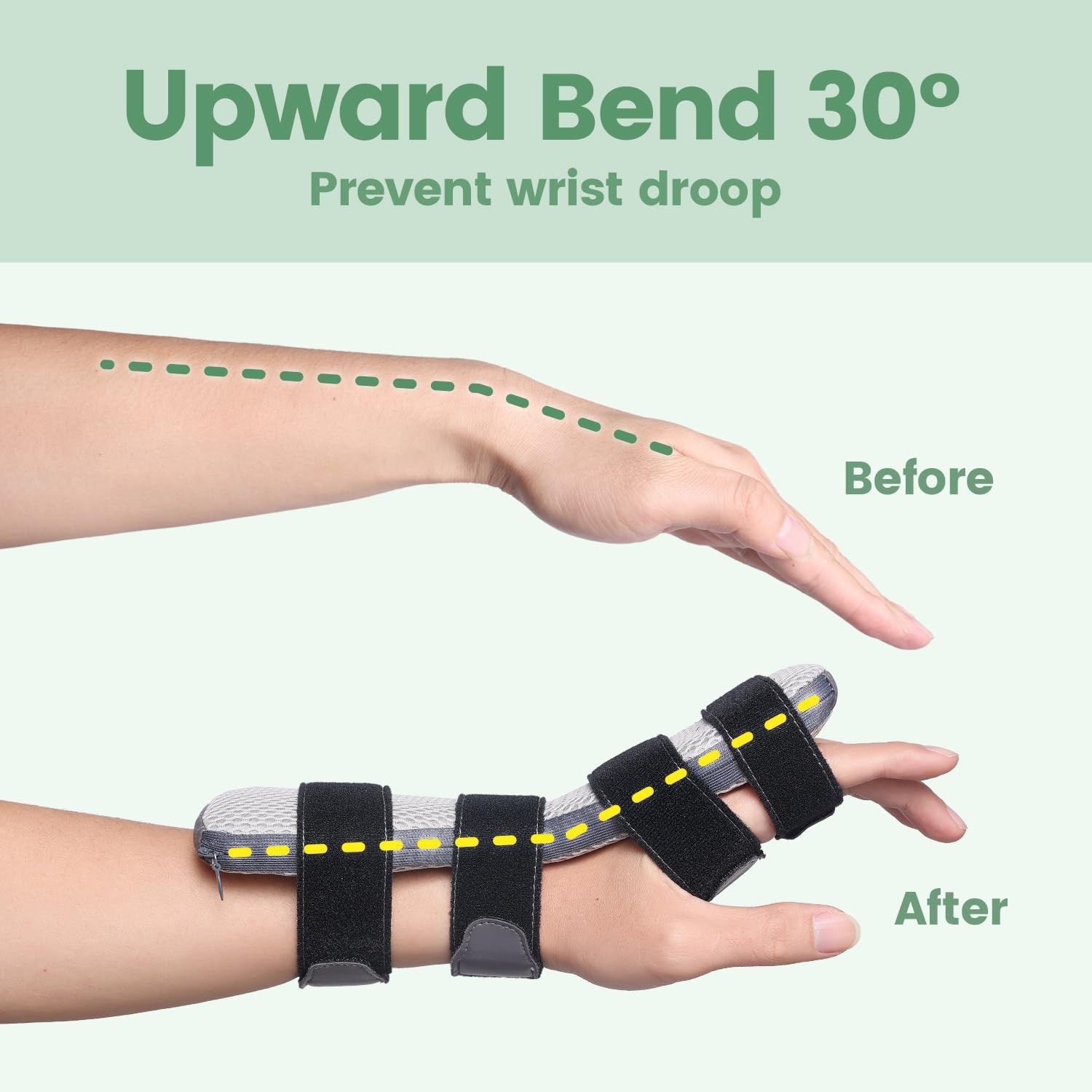 Radial Nerve Palsy Splint for Wrist Drop, Adjustable Static Fingers Fixation …