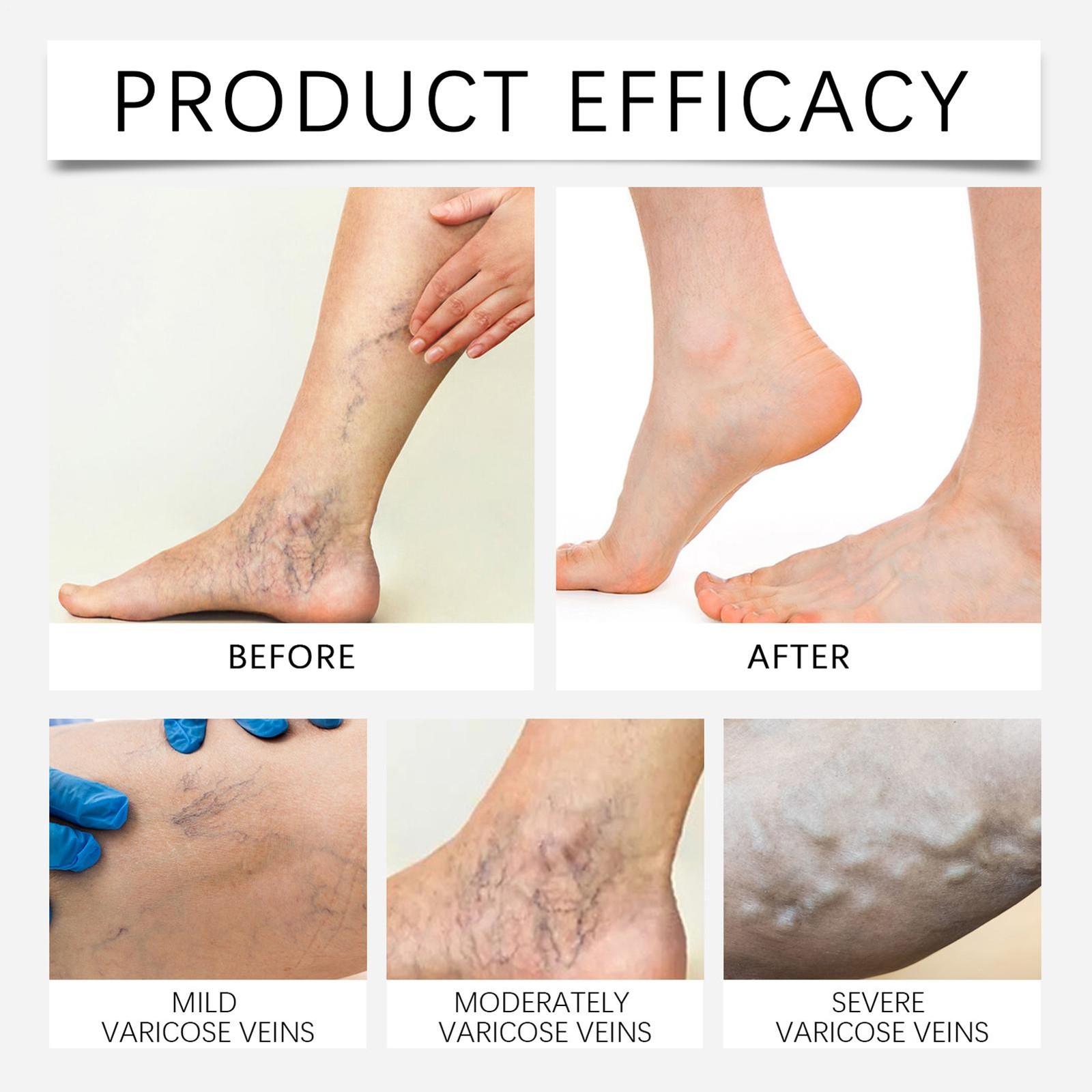 2026 Vein Target Microneedle Patch Natural Ingredients Leg Care Patch New