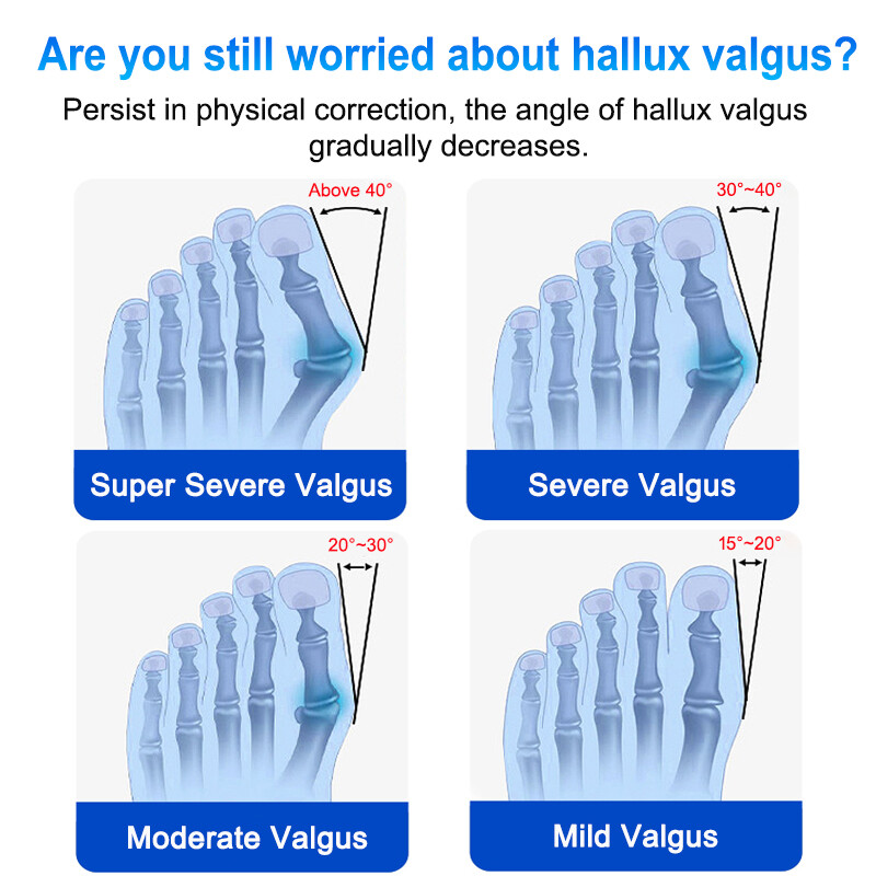 Orthopedic Big Toe Bunion Corrector Hallux Valgus Straightener Splint Support US