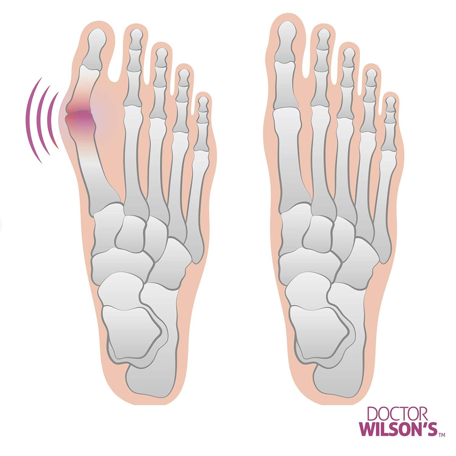 2 Bunion Relief Pads Sleeve – Splint 2 Count (Pack of 1), Nude