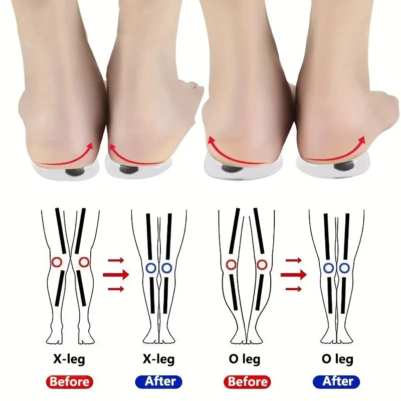 1Pair Orthopedic Insoles for Feet O/X Leg Type Valgus Correction Men Women Silic