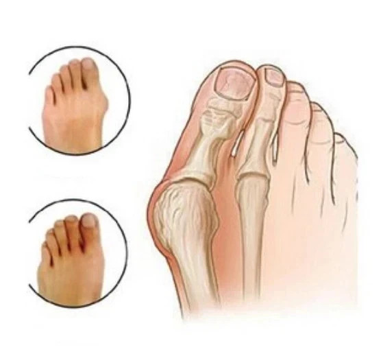 Hallux Big Toe Separator Straightener Bunion Valgus Splint Corrector Support UK