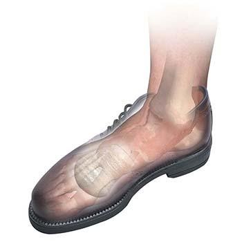 Hapad Metatarsal Bars