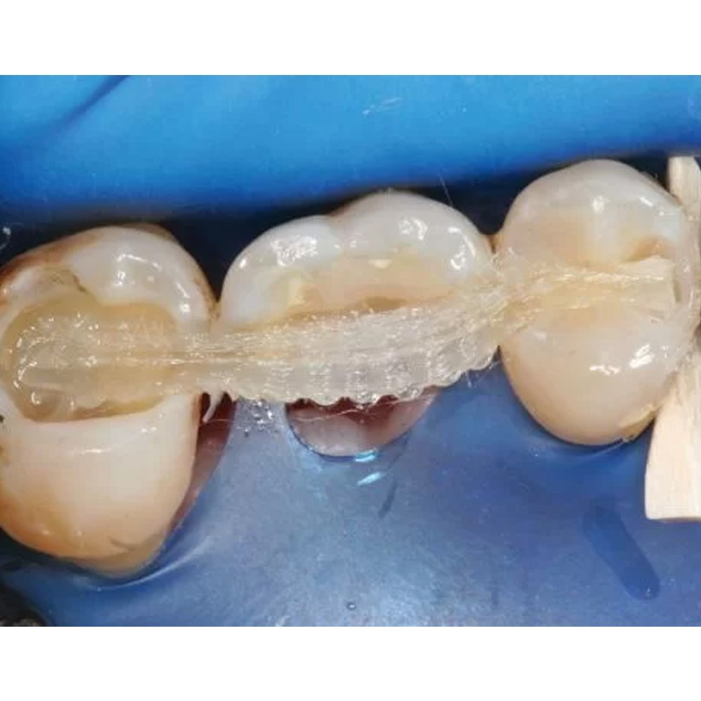 Polydentia Fiber-Splint With Clips All Size