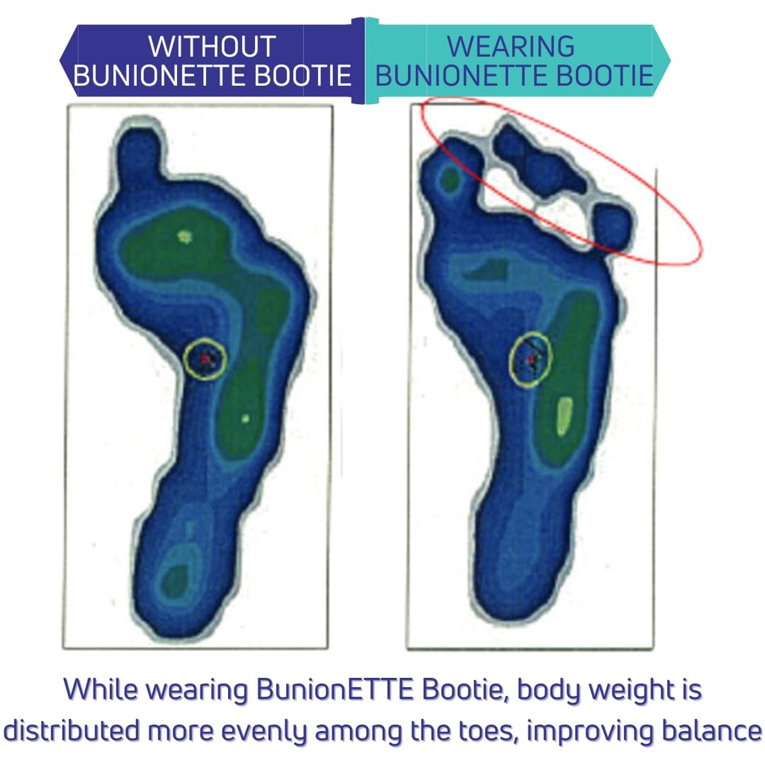 BunionETTE Bootie – Tailor’s Bunion Corrector for Little Toe Alignme