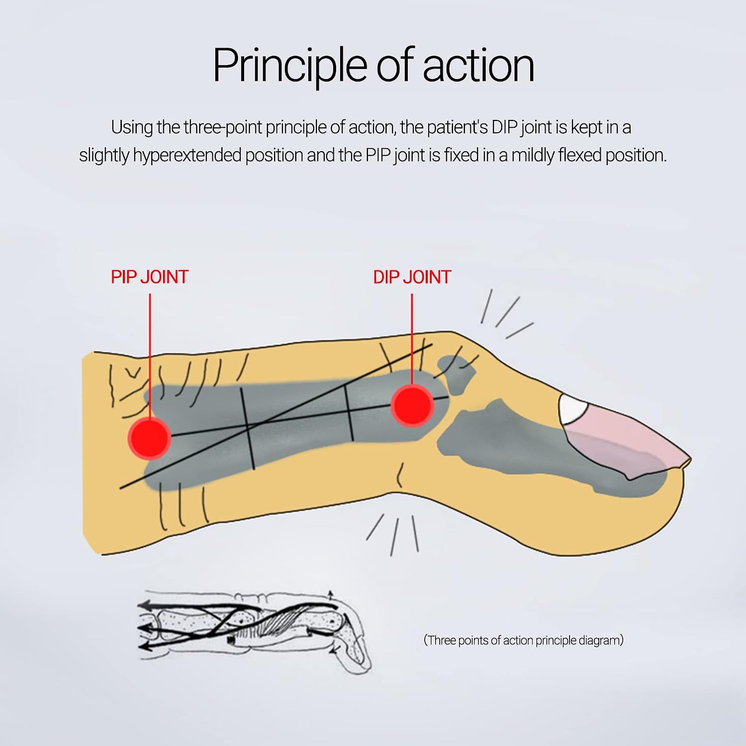 2 Pieces Finger Splint Mallet Finger Support Finger Splint Brace Plastic Prot…