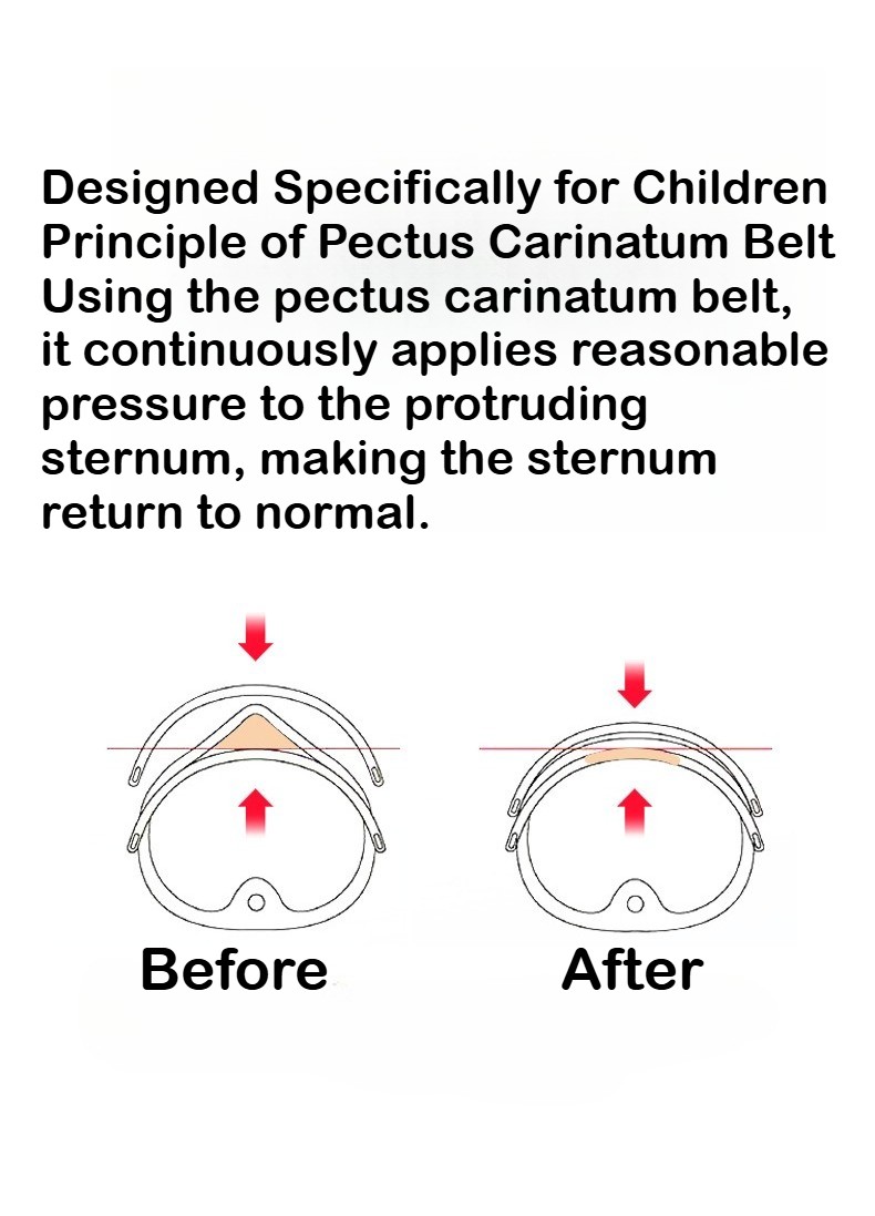 Pectus Carinatum Brace Adjustable Buckle Pigeon Chest Support Corset For Child
