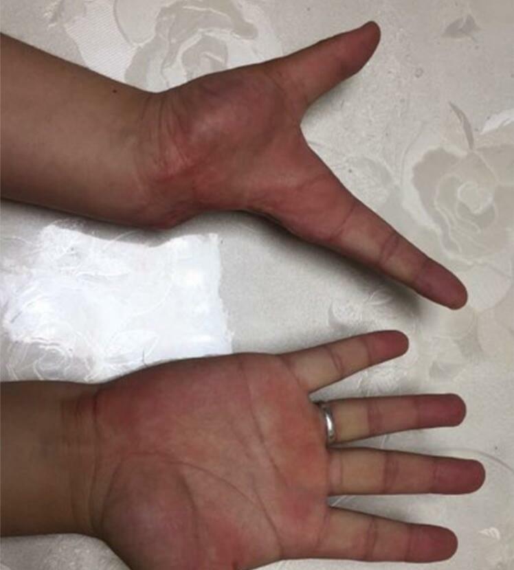 Silicone Prosthesis Hand Sleeve Highly Simulated Skin Artificial Arm Cover Scars