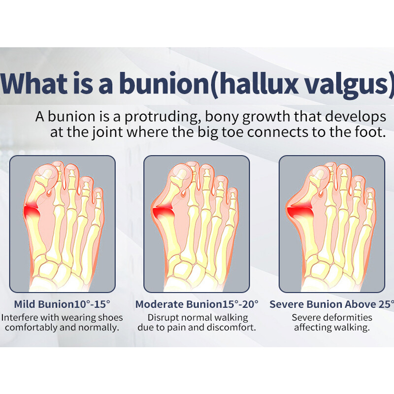 Bunion Corrector Hallux Valgus Big Toe Straightener Splint Separator Pain Relief