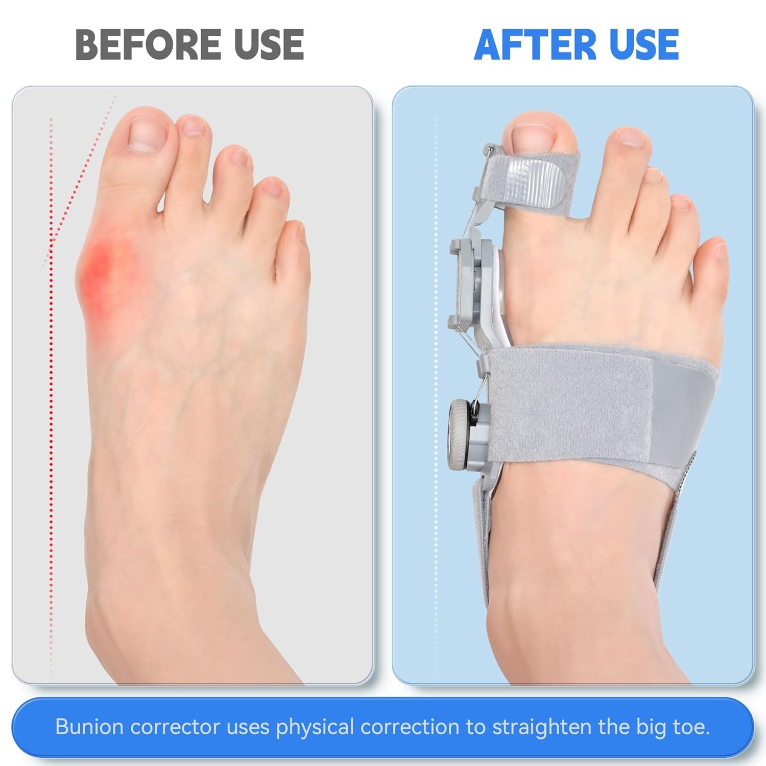 Bunion Corrector for Women & Men,Adjustable Universal Size Universal, Grey