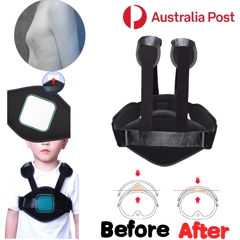 Pectus Carinatum Brace Adjustable Buckle Pigeon Chest Support Corset For Child