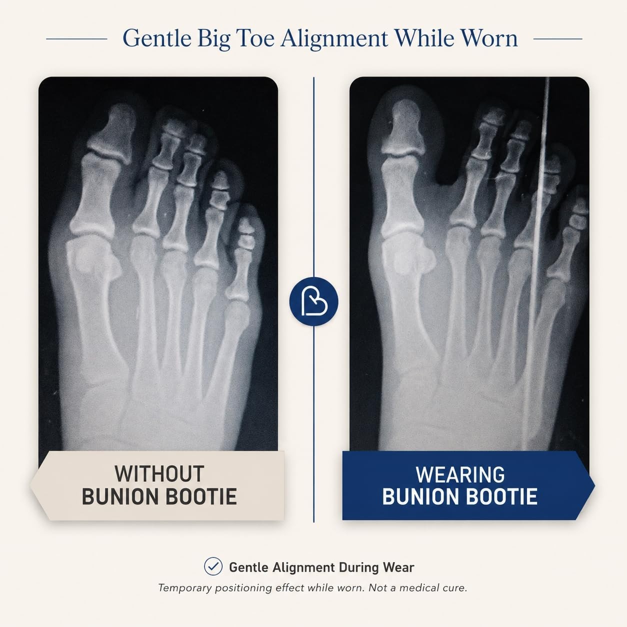 Bunion Corrector for Women Big Toe Straightener. Ultra-Thin Bunion Brace – b3