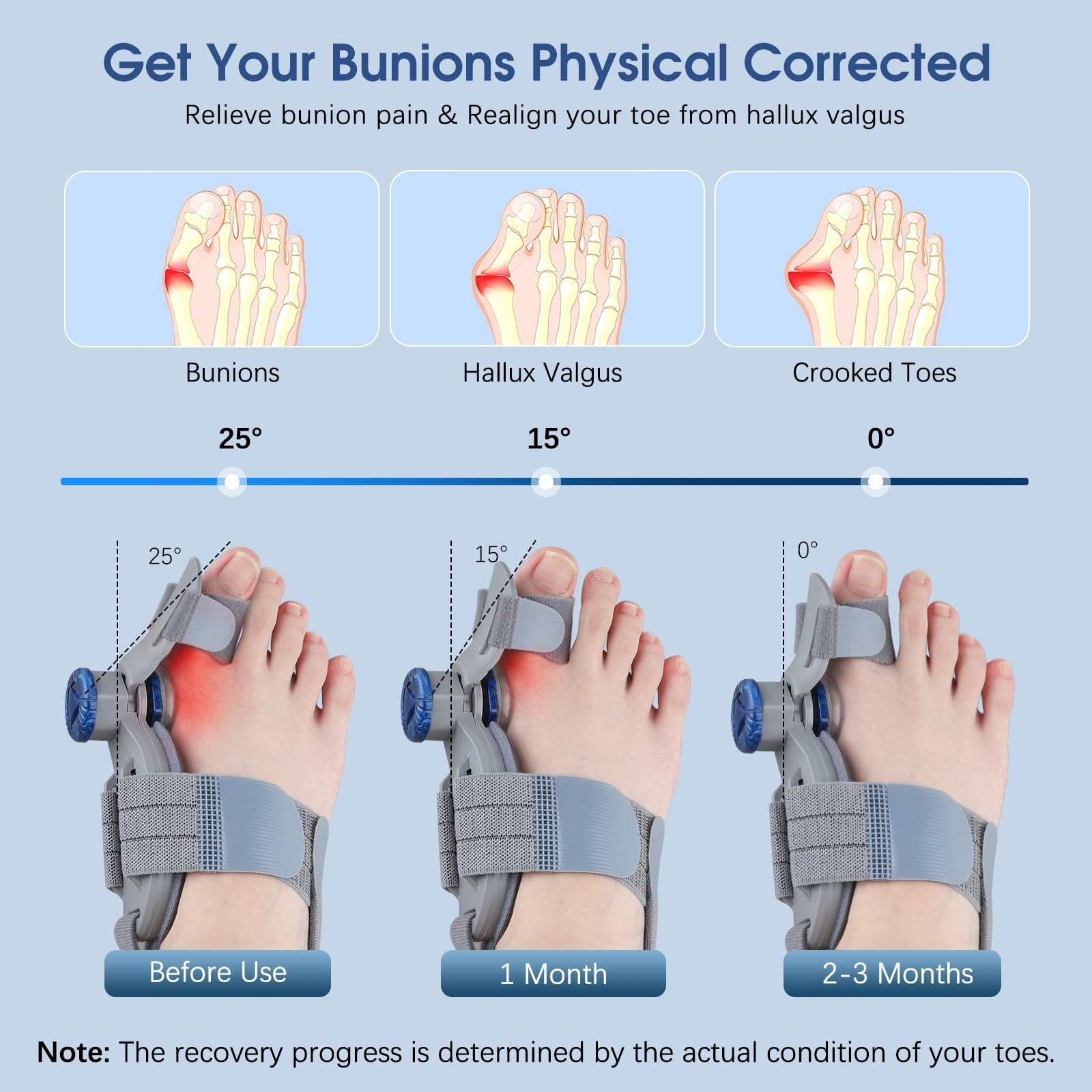 Adjustable Bunion Corrector for Women & Men – Toe Alignment Splint for Pain Reli