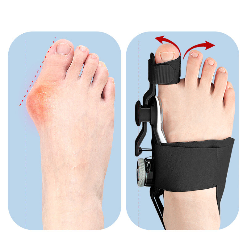 Unisex Bunion Corrector Hallux Valgus Corrector Orthopedic Big Toe Separator NCW