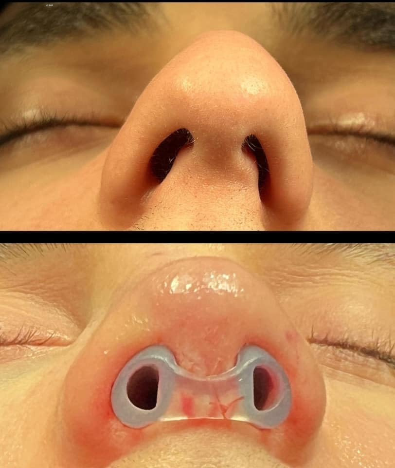 Silicone Nostril Retainer for Rhinoplasty Surgery 100% Silicone 10 Size
